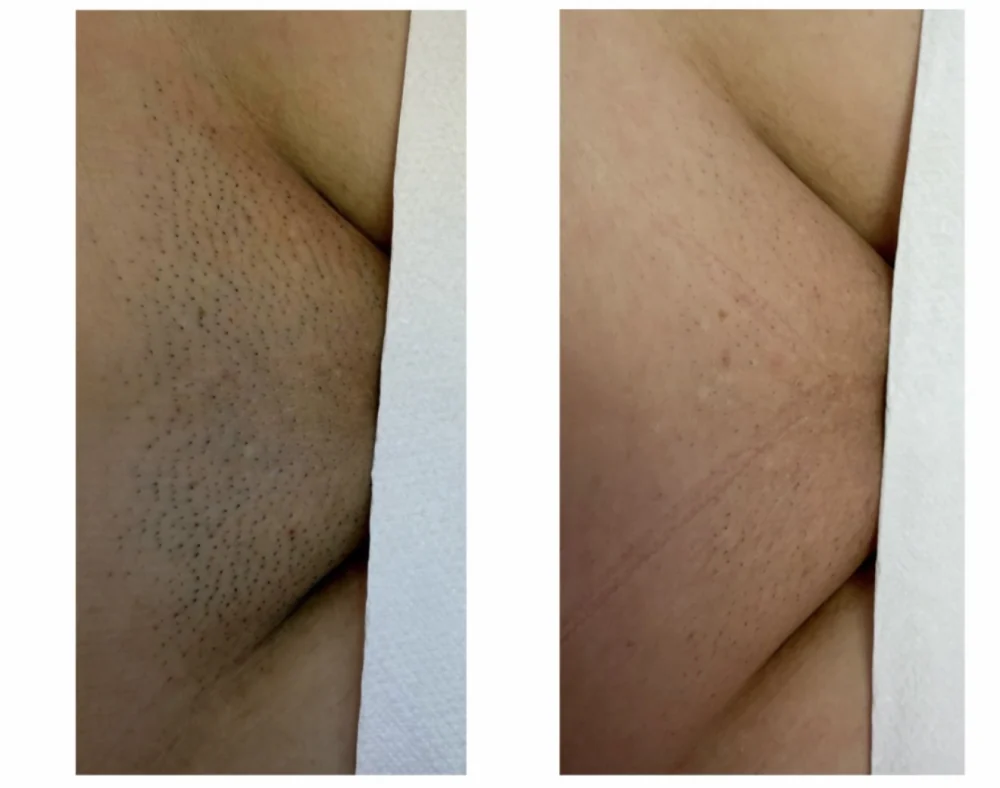 Individuální příklad výsledku laserové epilace po 5 ošetřeních