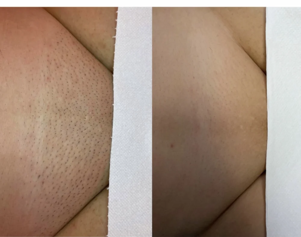 Individuální příklad výsledku laserové epilace po 8 ošetřeních